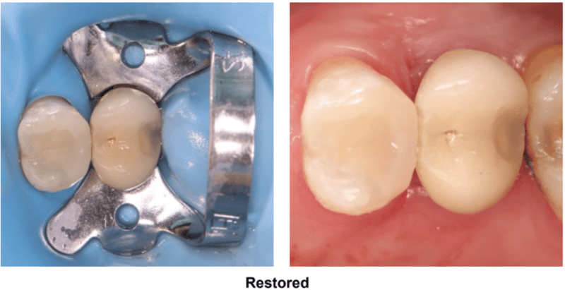 Deep Class II Restoration on Tooth #12 DO Restored