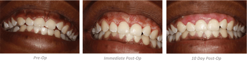 Laser Gingivectomy and Depigmentations Pre and Post Op