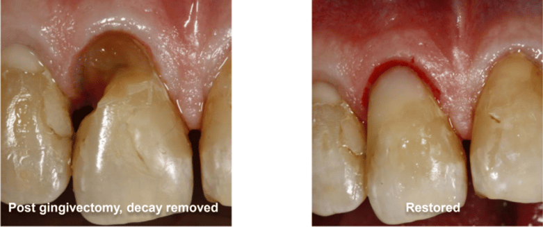 Gingivectomy and Restoration on Tooth #8 Technique Used