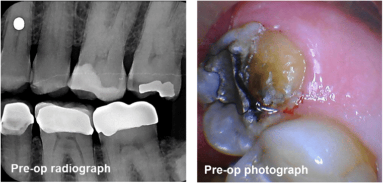 Crown Lengthening (Closed) #15 Pre-Op