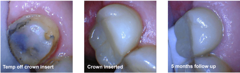 Crown Lengthening (Closed) #15 Results