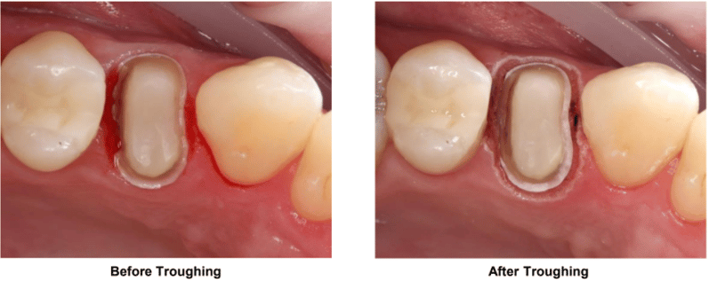 Deep Troughing for Margin Isolation #5 Before and After Troughing