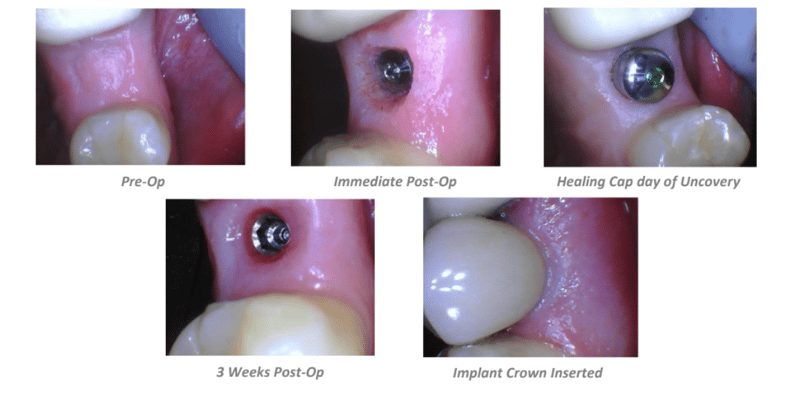 Implant Uncovery on Tooth #4 Case Summary
