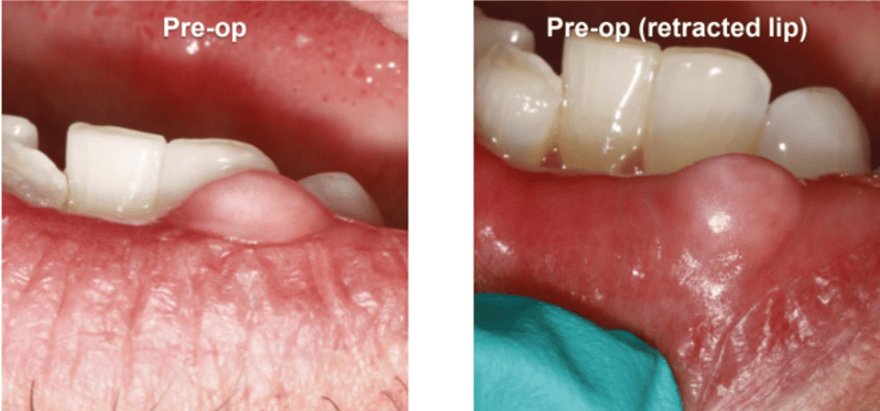 Fibroma Removal Pre-Op