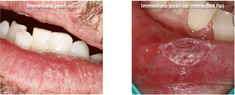 Fibroma Removal Post-Op