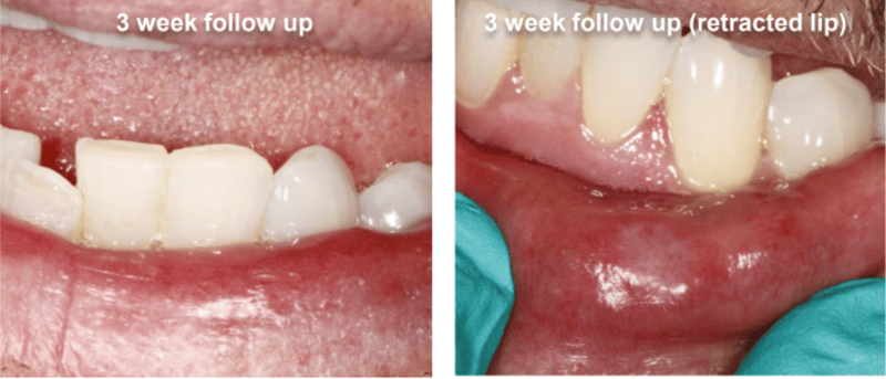 Fibroma Removal Follow Up