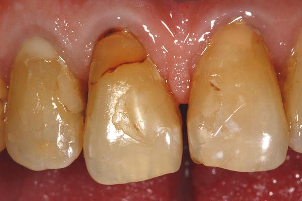 Saving teeth- Changing the hopeless prognosis with new technology