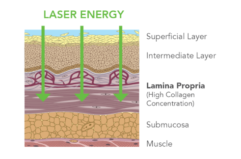 Graphic of soft palate tissue lasers, showing the Solea Sleep laser energy goes into the lamina propria.