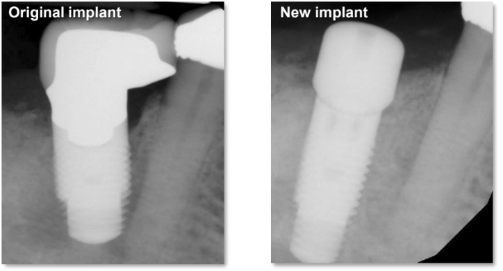 Tissue Recontouring for Implant Restoration 2 Original and New Implant