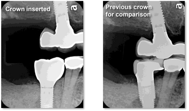 Tissue Recontouring for Implant Restoration 2 Results