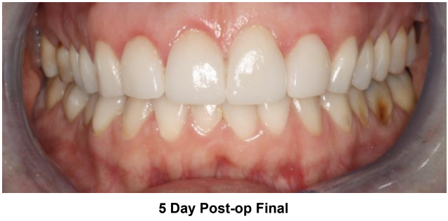 Anterior CEREC Veneers with Esthetic Crown Lengthening Using Solea Post-Op