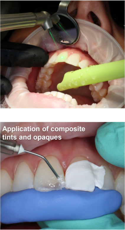 Class IV (Esthetic Composite Removal) Technique Used