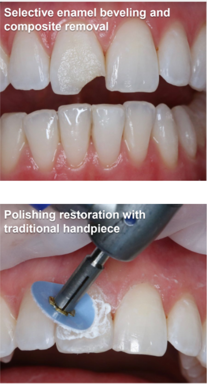 Class IV (Esthetic Composite Removal) Polishing Restoration 