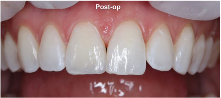 Class IV (Esthetic Composite Removal) Post-Op