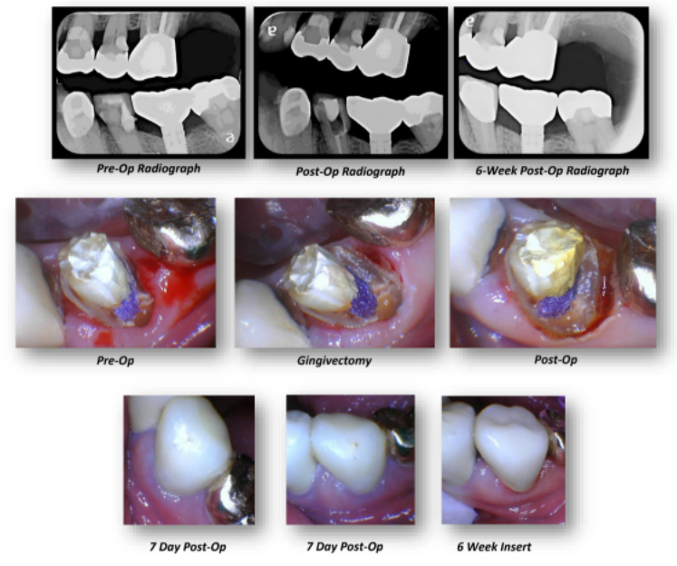 Crown Lengthening #20 (Closed) Case Summary