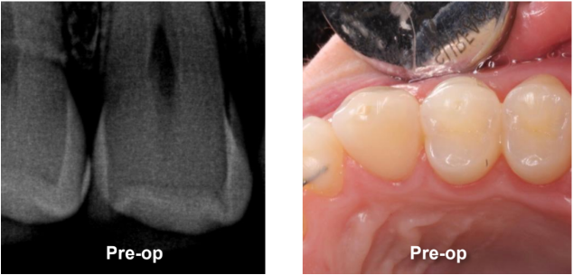 Class II Composite Resin Restoration on Tooth #5 DO Pre-Op