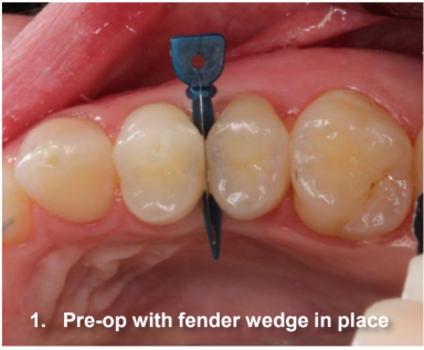 Class II Composite Resin Restoration on Tooth #5 DO Pre-Op with fender wedge