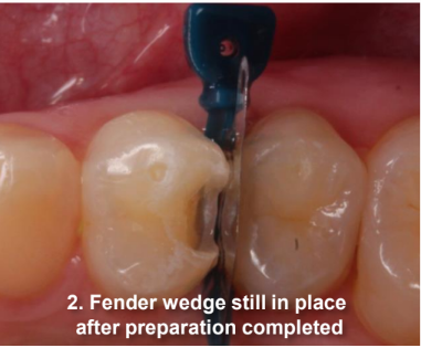 Class II Composite Resin Restoration on Tooth #5 DO fender wedge still in place