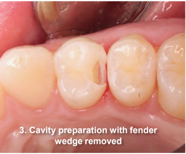 Class II Composite Resin Restoration on Tooth #5 DO cavity preparation with fender wedge removed