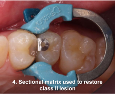 Class II Composite Resin Restoration on Tooth #5 DO sectional matrix