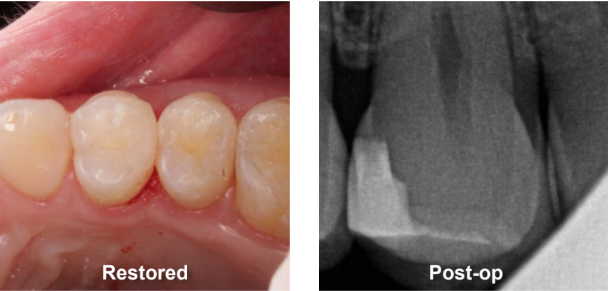 Class II Composite Resin Restoration on Tooth #5 DO Restored and Post-Op