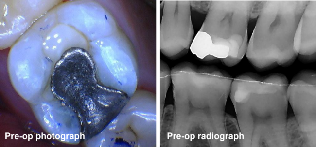 Amalgam Removal on Tooth #14 and Class II Restoration on Tooth #13 Pre-Op