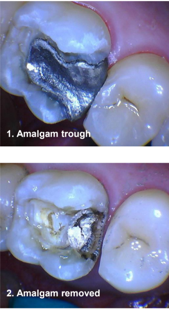 Amalgam Removal on Tooth #14 and Class II Restoration on Tooth #13 Trough and Removal