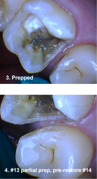 Amalgam Removal on Tooth #14 and Class II Restoration on Tooth #13 Prepped