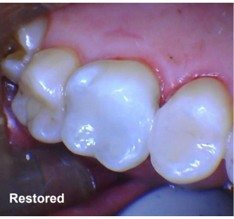 Amalgam Removal on Tooth #14 and Class II Restoration on Tooth #13 Restored