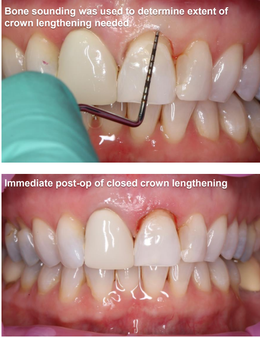 Crown Lengthening (Closed) #9 Technique Used