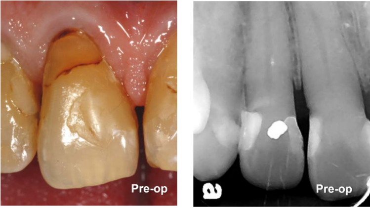 Gingivectomy and Restoration on Tooth #8 Pre-Op