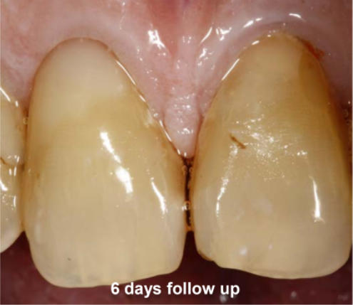 Gingivectomy and Restoration on Tooth #8 Follow Up