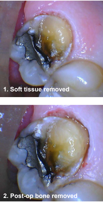 Crown Lengthening (Closed) #15 Soft Tissue and Post-Op Bone Removed