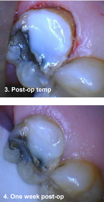 Crown Lengthening (Closed) #15 Post-Op Temp and One Week Post-Op