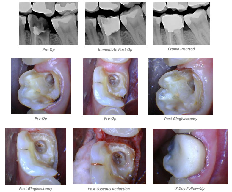 Open Crown Lengthening #19 Case Summary