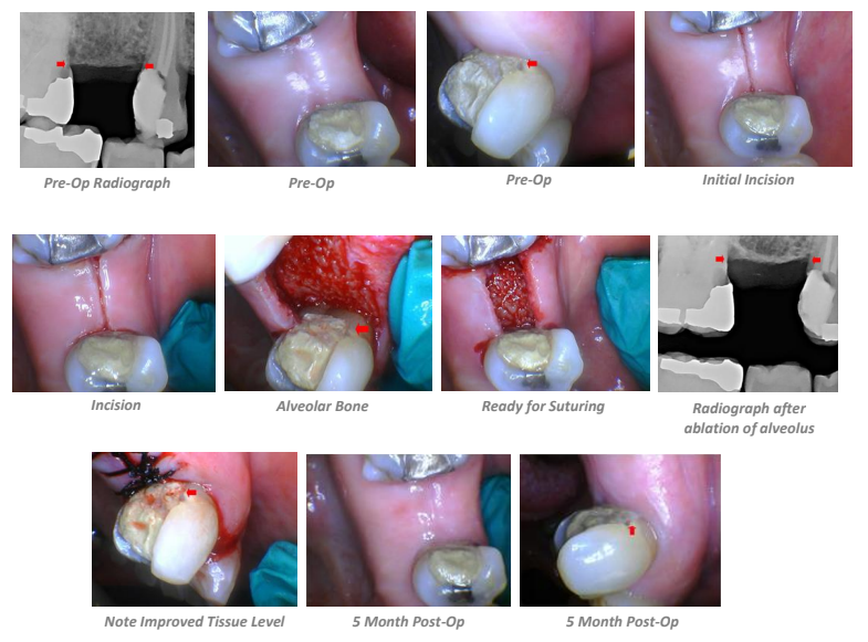 Open Crown Lengthening #3 and #5 Case Summary