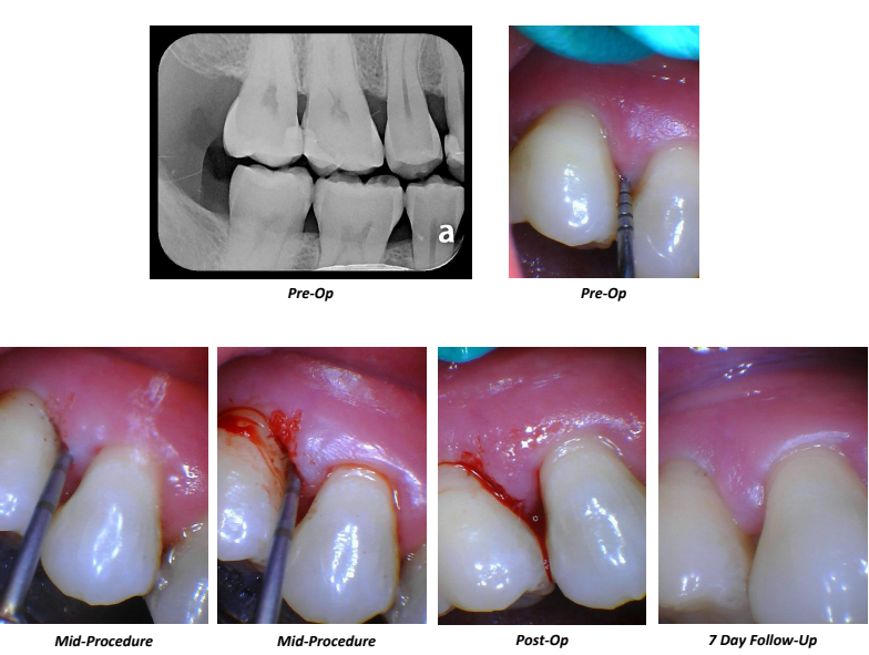 Closed Flap with Ultraguide Case Summary