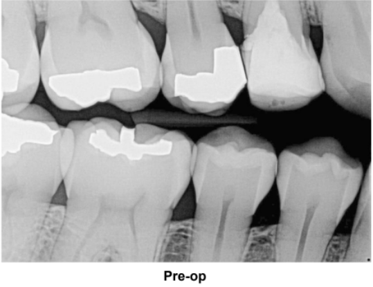 Deep Troughing for Margin Isolation #5 Pre-Op