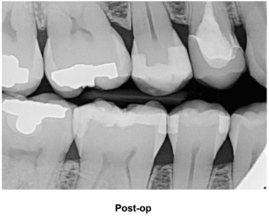 Deep Troughing for Margin Isolation #5 Post-Op